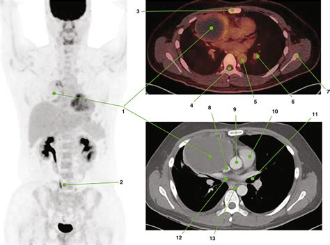 And Anatomy Of Petct Radiology Key