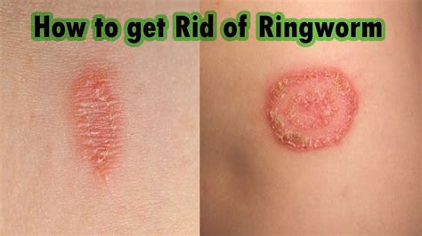 Ringworm Treatment At Home 7 Steps On How To Cure Ringworm Fast