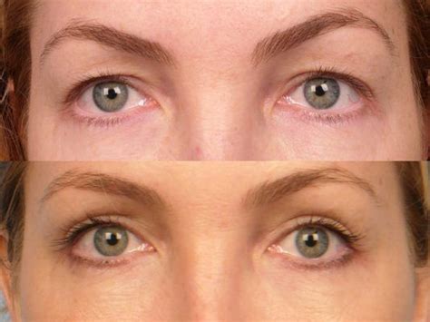 How To Get Rid Of Sagging Eyelids With This Method Naturally