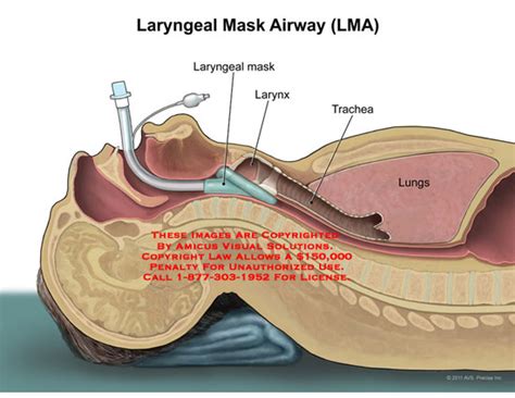 Amicus Illustration Of Amicusmedicallarynxlaryngealmaskairwaylma