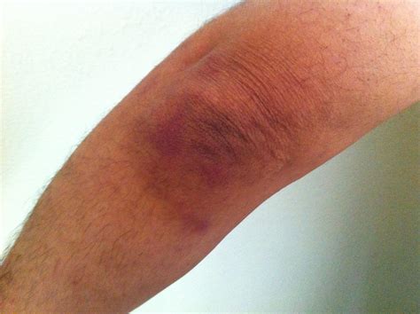 Injury Photo 1 Piccuta Law Group Car Accident Lawyers