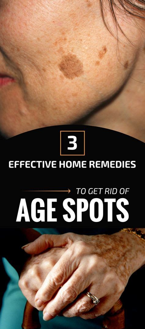 3 Effective Home Remedies To Get Rid Of Age Spots Brown Spots On Face Spots On Face Age