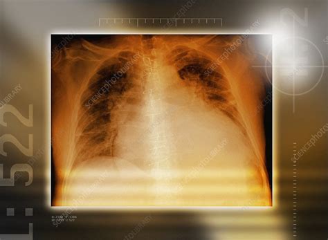 Heart Failure Chest X Ray Stock Image M172 0594 Science Photo