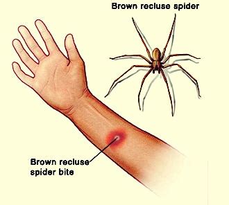 Brown Recluse Bite Stages Progression Pictures Treatment