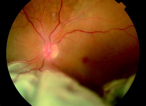 Management Of Retinal Detachment A Guide For Non Ophthalmologists