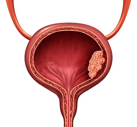 repeat turbt before rc does not improve bladder cancer outcomes renal and urology news