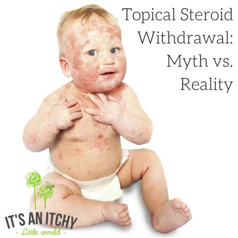 Topical Steroid Withdrawal Myth Vs Reality