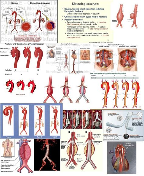 102 Best Aortic Aneurysms Images On Pinterest Aortic Aneurysm Aortic