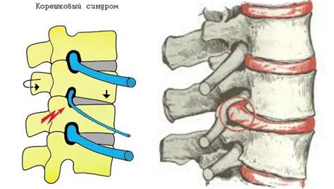 Lumbar Radic Patterns