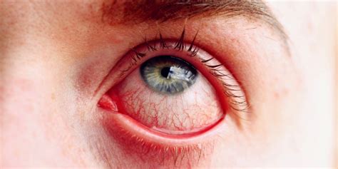 How To Treat Pink Eye It Depends On What Type You Have