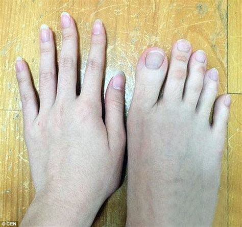 Fingers Or Toes Woman Stuns Internet After Posting Pictures Of Her