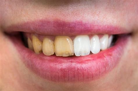 Surprising Natural Remedies For Yellowing Teeth Daily Health Alerts
