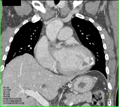 Infarct With Calcification Left Ventricle Wall Cardiac Case Studies
