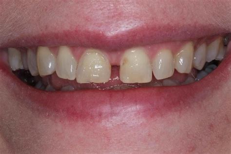 Before And After Dental Bonding Photos Cosmetic Bonding Dentists