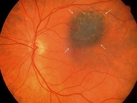 Nevusfreckle In The Eye Risk Factors Of Melanoma Nevi