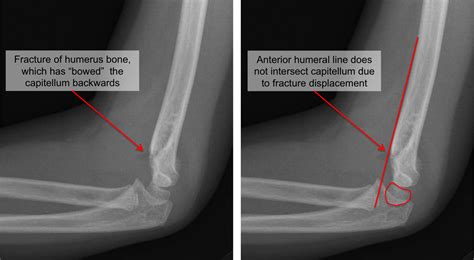 Kids Elbow Fracture Raleigh Hand Surgery — Joseph J Schreiber Md
