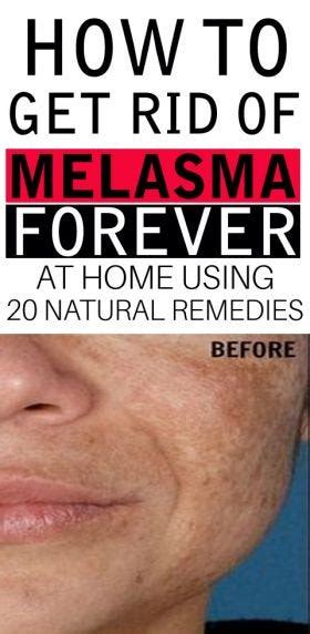 How To Get Rid Of Melasma Forever With 20 Home Remedies By Beauty
