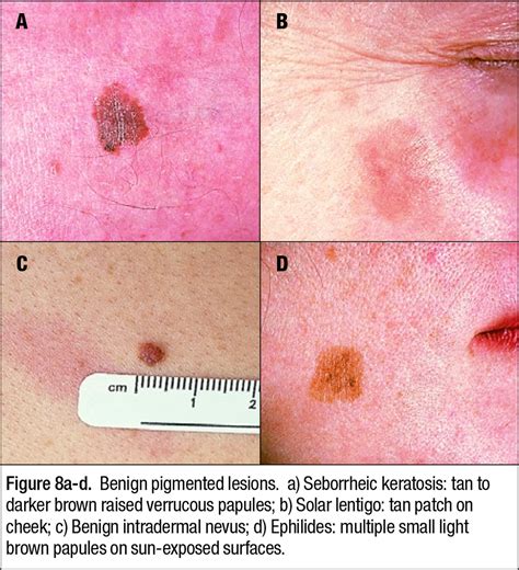 Malignant Melanoma Prevention Early Detection And Treatment In The
