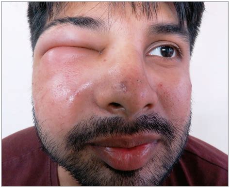 A Case Of Recurrent Unilateral Periorbital Edema Associated With