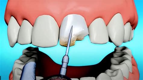 Chipped Tooth Garland Tx Broken Teeth Treatment Dental Filling