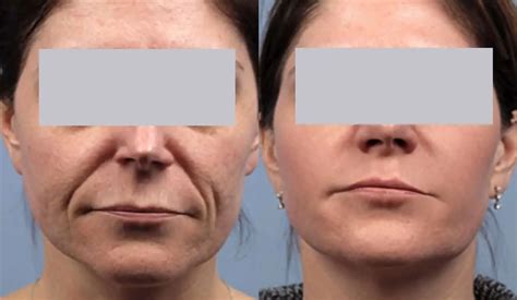 Non Surgical Facelift Before And After