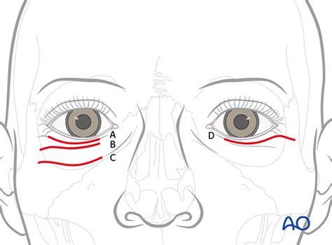 Transcutaneous Lower Eyelid Approaches