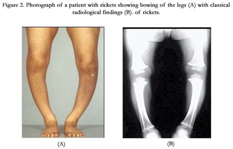 What Is Rickets Symptoms Causes And How To Manage It