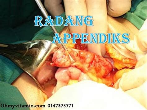 Ada dua cara kelahiran iaitu secara normal dan pembedahan.di sini kita kongsikan petua dimana dapat menyembuhkan luka jahitan selepas bersalin terutamanya bagi yang bersalin normal. CARA DOKTOR NADIA SEMBUHKAN LUKA PEMBEDAHAN BERSALIN DAN ...