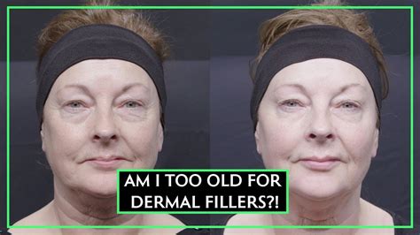 can you be too old for dermal fillers youtube