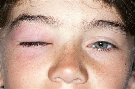 Allergy Causing A Swollen Eye Stock Image C0110366 Science Photo