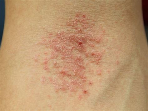 Eczemaatopic Dermatitis Mclean And Woodbridge Va