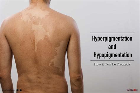 Hyperpigmentation And Hypopigmentation How It Can Be Treated By Dr