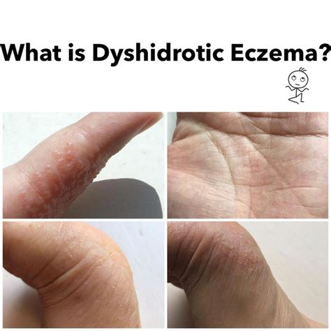 What Is Dyshidrotic Eczema Blisters On Fingers Hands And Feet