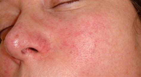 Redness Around Nose Under Dry Skin Red Rash Bumps Causes Treatment