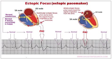 Ectopic Focus P Wave Deep Learning Cardiac Rhythms