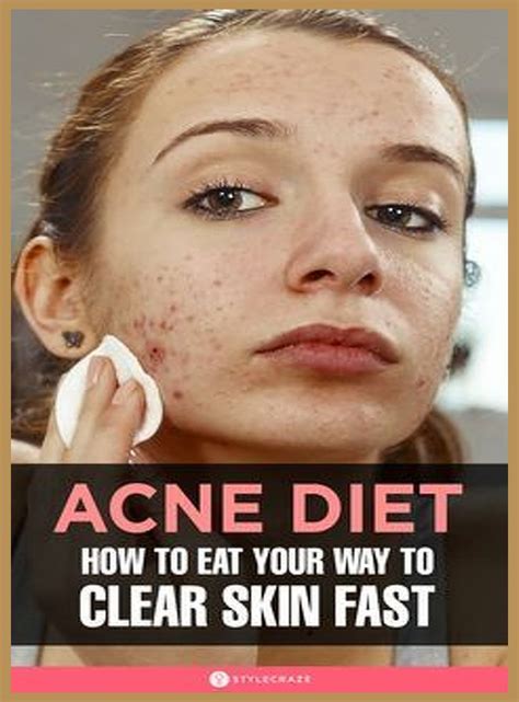 Pin On Acne Cause