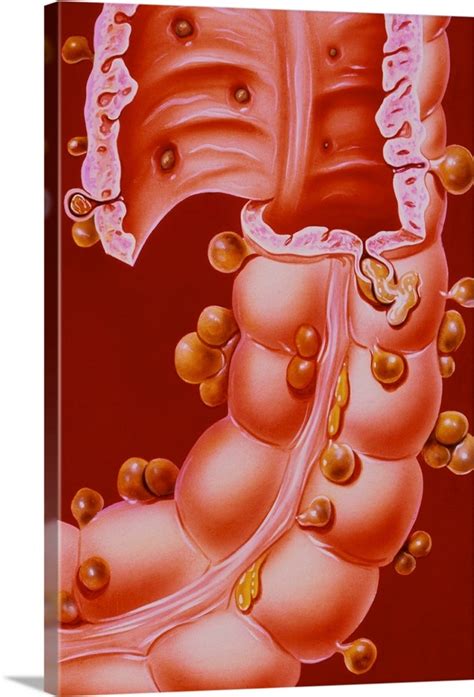 Illustration Showing Diverticulitis Of The Colon Wall Art Canvas