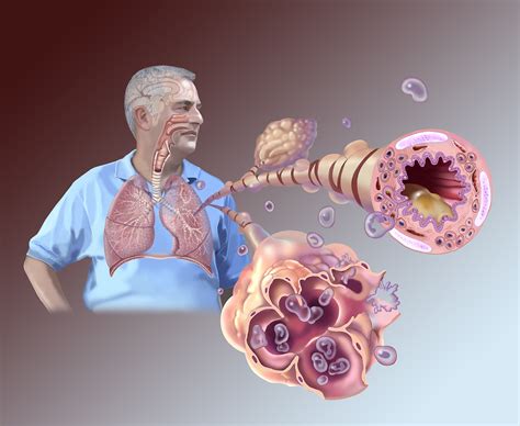 Bronchitis Archives Jackie Heda Biomedical And Scientific Visuals