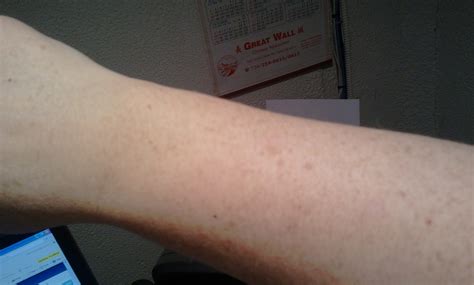I Had One Small Dark Red Little Skin Spot On My Arm I Noticed