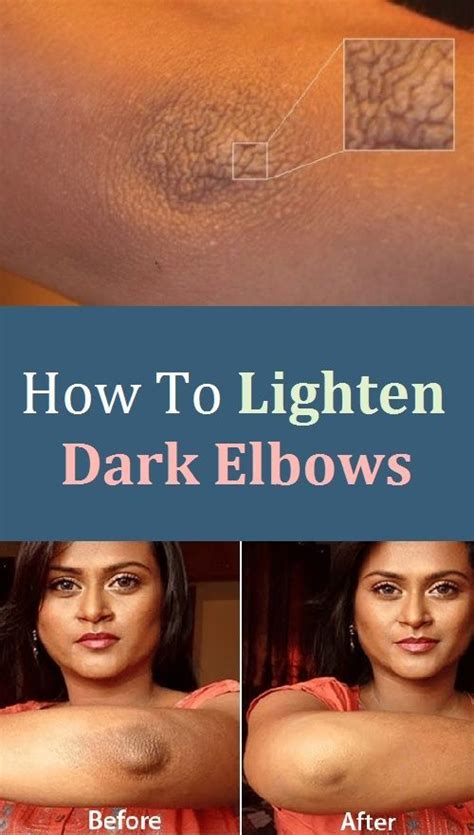 How To Lighten Dark Elbows Dark Elbows Skin Hyperpigmentation