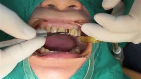 Abfraction Teeth Restored With Herculite Precis Youtube