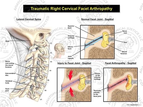 Neck pain is common in the general population and even more common in a chronic pain management practice. Traumatic Right Cervical Facet Arthropathy