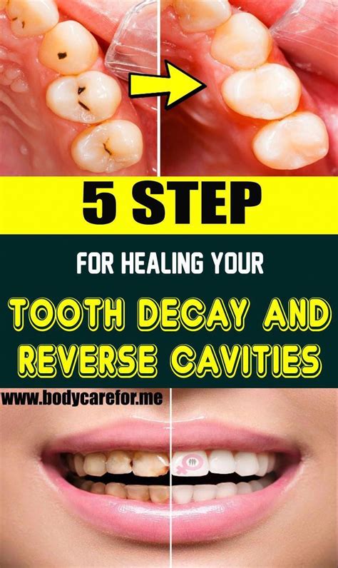 5 Steps For Healing Your Tooth Decay And Reverse Cavities Health
