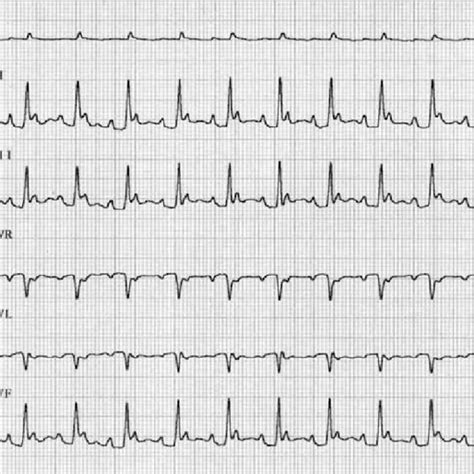 Six Lead Ecg Tracings Obtained From A 14 Year Old Domestic Medium Hair