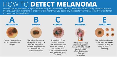M T Om Dia How To Detect Melanoma Using The Abcde Method