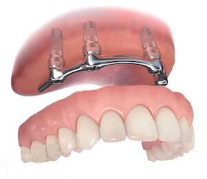 Implantes Dentales En Madrid Precios Y Opiniones Cl Nica Dr Ferrer