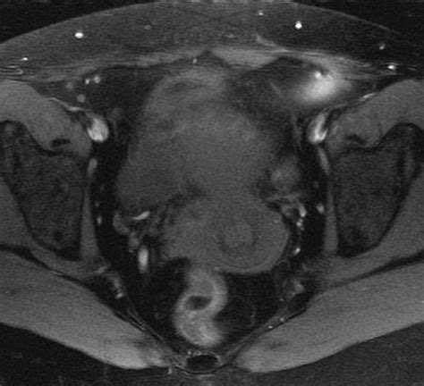 T1 Weighted Fat Suppressed Imaging Of The Pelvis With A Dual Echo Dixon