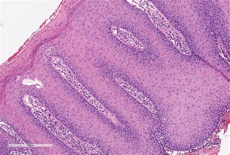 Pathology Outlines HPV Independent Squamous Cell Carcinoma Vulva