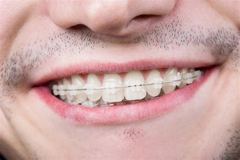 Ventajas Y Falsos Mitos De Los Brackets Espai Dental Olve