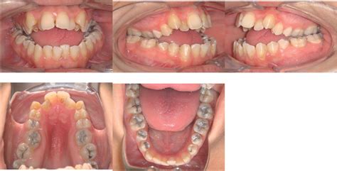 Combined Surgical And Orthodontic Management Of Maxillofacial